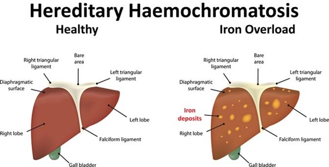 Hemochromatosis