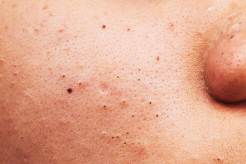 How to remove blackheads?