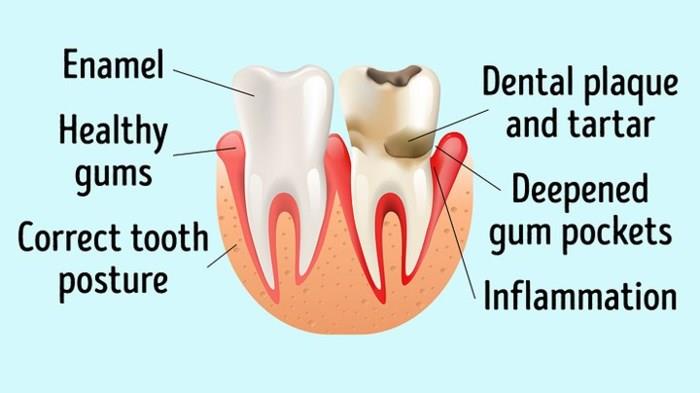 Infectious tooth diseases