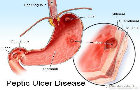 Stomach Ulcers