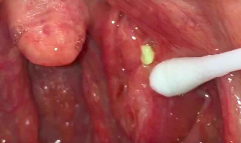 Treating tonsil stones