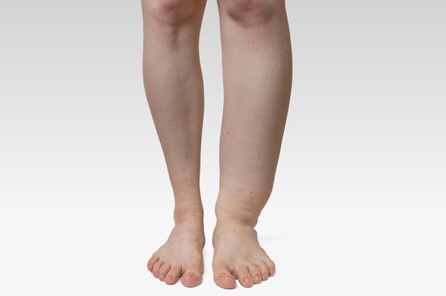 Overview of elephantiasis