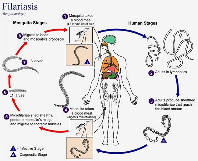 What is the cause behind elephantiasis