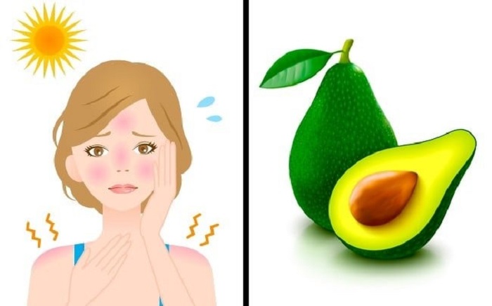 To help with sunburns and inflammation: use avocados